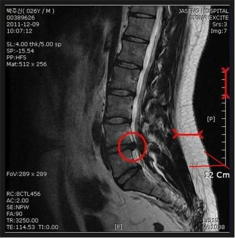 박주신 씨의 자생한방병원 MRI 사진