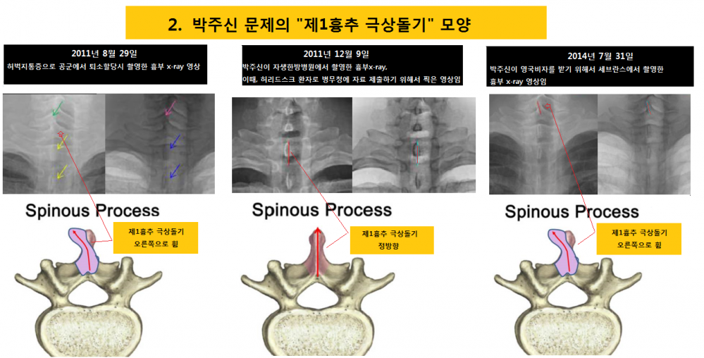 박주신 씨 X-ray 사진에 나타났던 극상돌기 문제 (관련 재판 법정브리핑 자료 중 일부로 알려져있음)