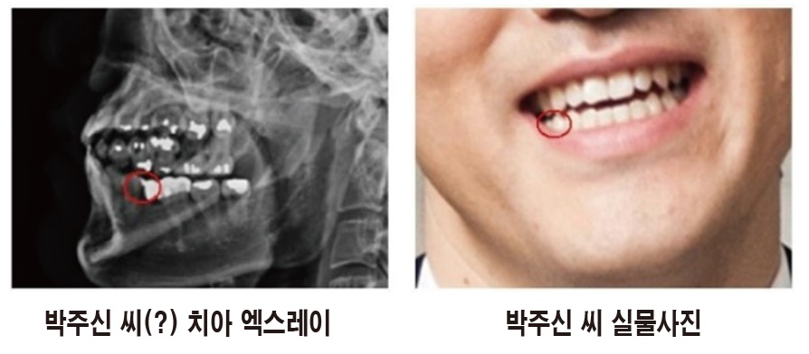 박주신 씨의 치아에 쏟아졌던 의혹